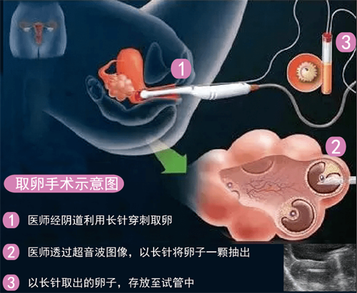 38岁去北京做试管成功率高吗：50岁绝经后做试管婴儿的成功率高吗？广西河池市人民医院试管婴儿的成功率是多少？