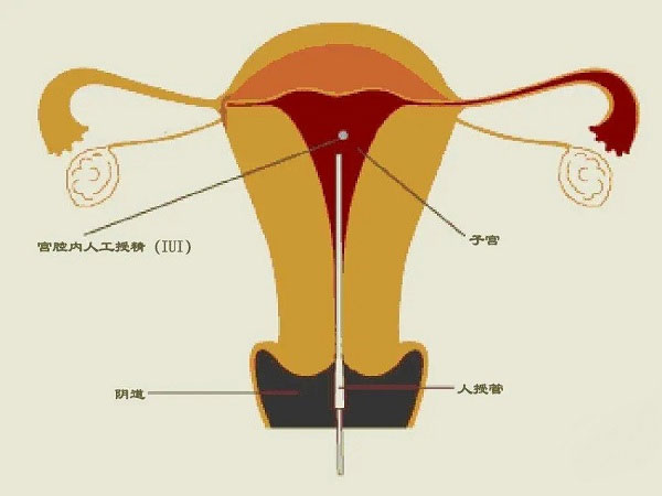 山西试管婴儿多少钱